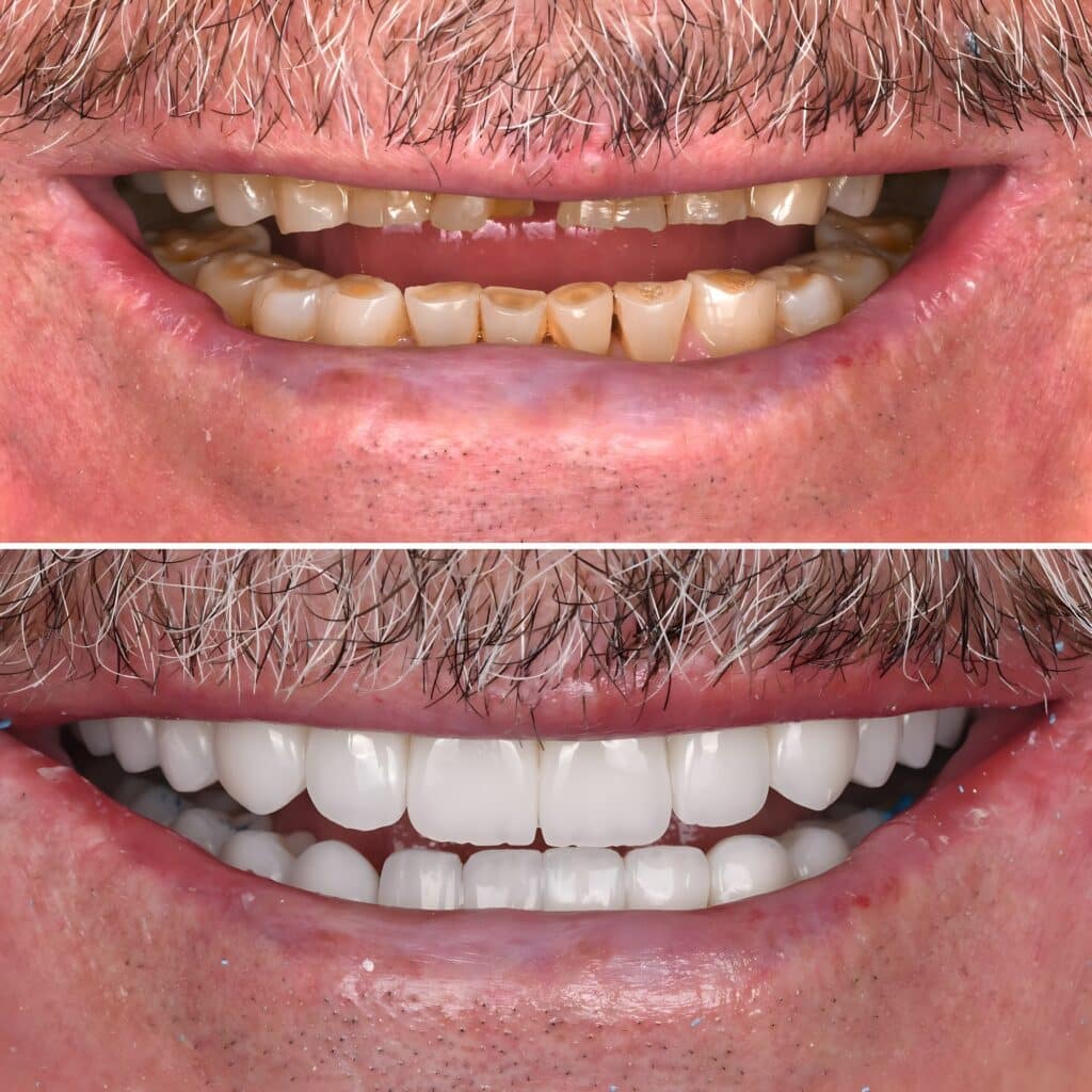 Full Mouth Rehabilitation Bishop